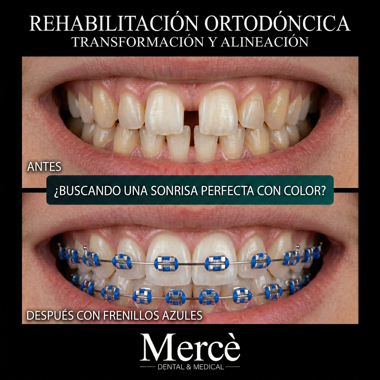 Caso de Éxito 5 - Implantes dentales